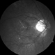 Lacquer Cracks in Pathologic Myopia